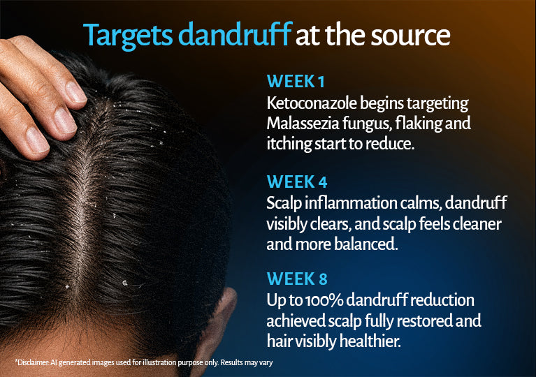2% Ketoconazole Shampoo